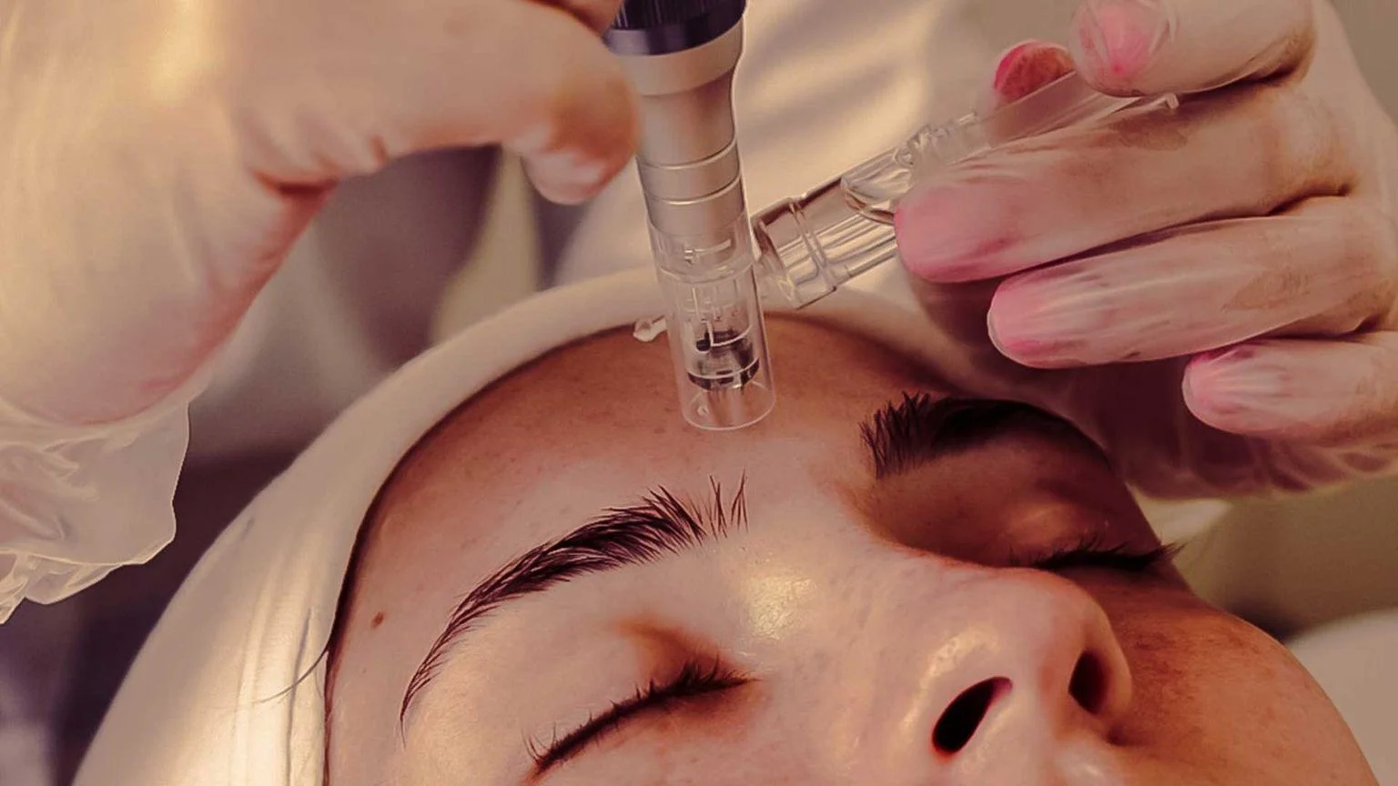 Best Microneedling Treatment in Wagholi Pune